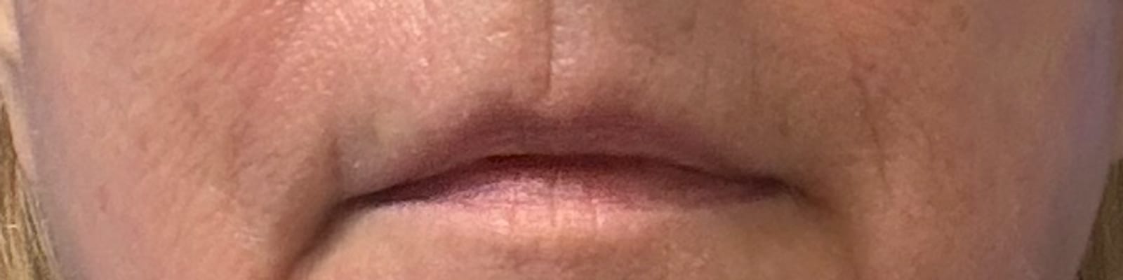 After ultraclear® laser — Softened vertical lip lines and a non-surgically lifted upper lip with UltraClear® 3D TechLift, six days post-treatment.