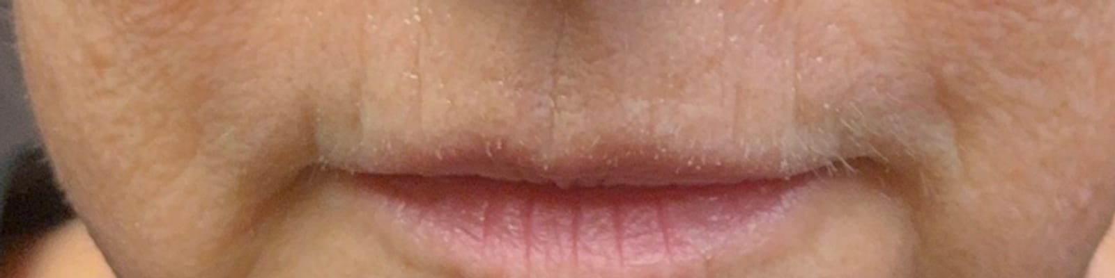 Before ultraclear® laser — Softened vertical lip lines and a non-surgically lifted upper lip with UltraClear® 3D TechLift, six days post-treatment.