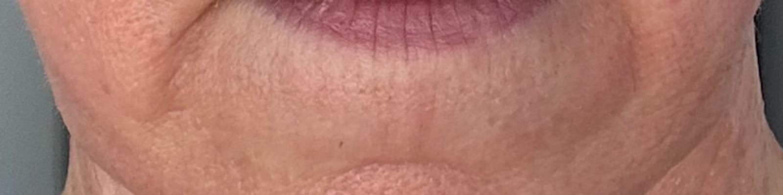 After ultraclear® laser — Improved marionette lines and a more defined jawline with UltraClear® 3D TechLift, five days post-treatment.