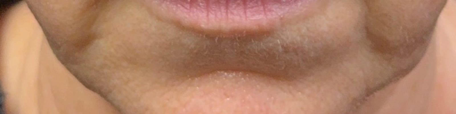 Before ultraclear® laser — Improved marionette lines and a more defined jawline with UltraClear® 3D TechLift, five days post-treatment.
