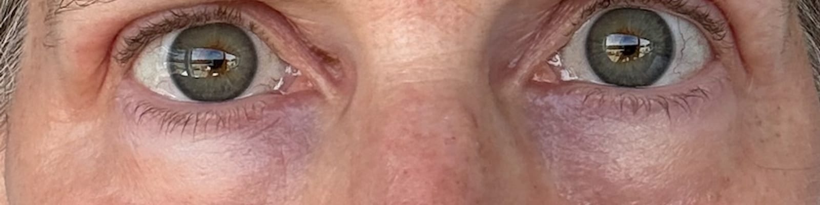 After ultraclear® laser — Reduced lower-eyelid bags and a smoother under-eye contour with UltraClear® 3D TechLift, five days post-treatment.