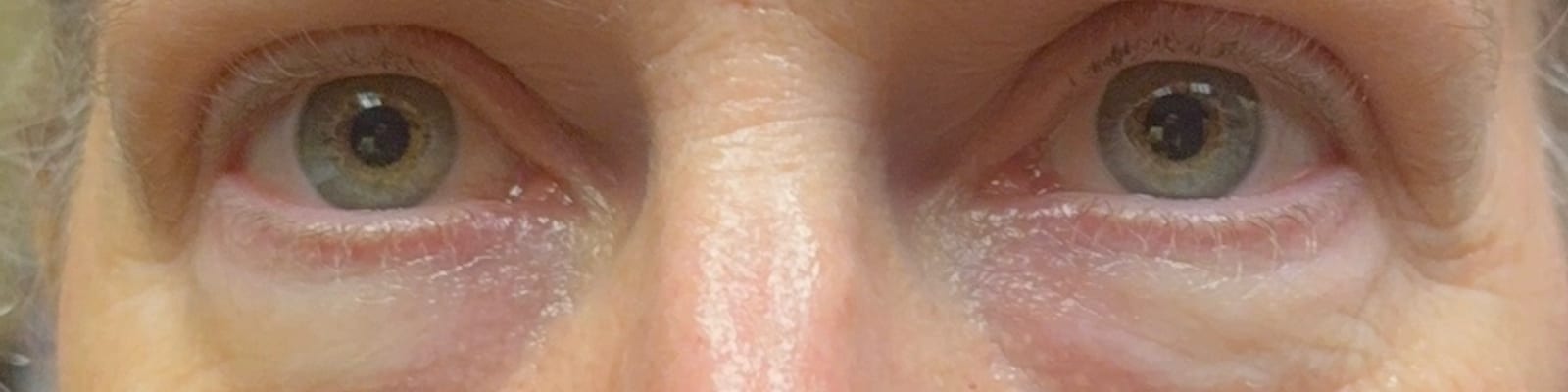Before ultraclear® laser — Reduced lower-eyelid bags and a smoother under-eye contour with UltraClear® 3D TechLift, five days post-treatment.