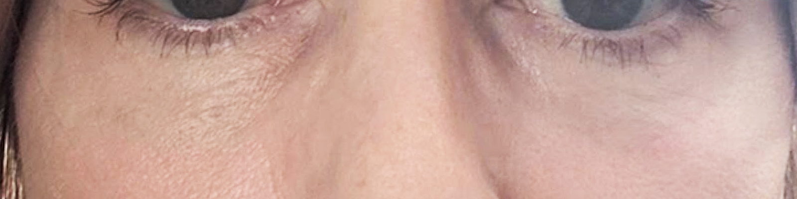 After ultraclear® laser — Softened lower-eyelid bags and under-eye creasing with UltraClear® 3D TechLift, seven days post-treatment.