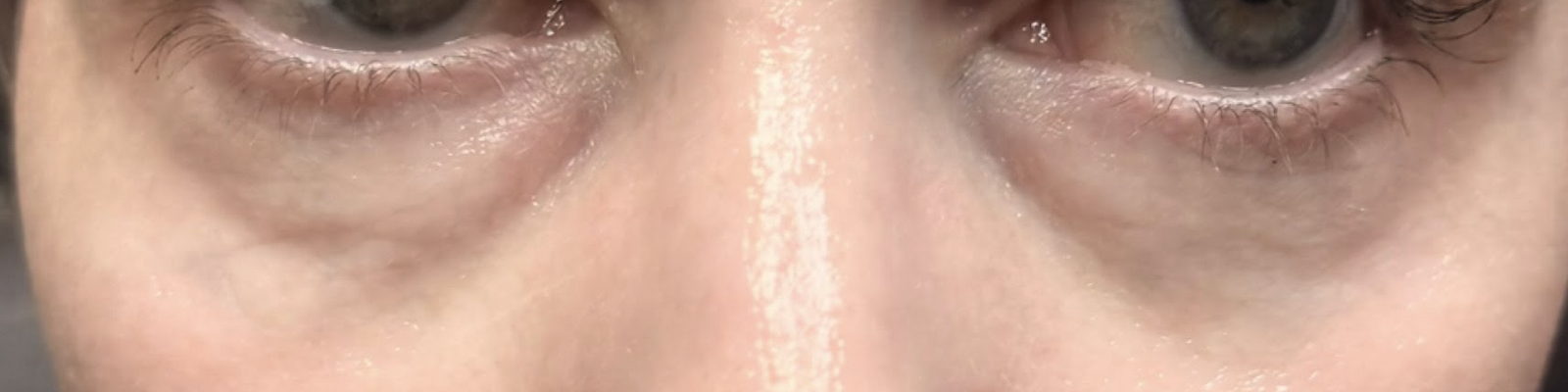 Before ultraclear® laser — Softened lower-eyelid bags and under-eye creasing with UltraClear® 3D TechLift, seven days post-treatment.